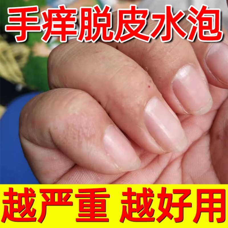 推荐汗泡疱疹药膏汉状真菌感染手气膏儿童专用治烂手丫手痒过敏外