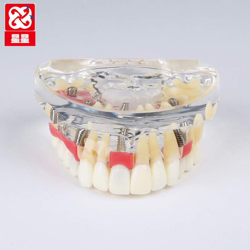 济宁星星种植演示模型 牙齿可拔 牙龈拆卸 种植钉演示牙齿模型